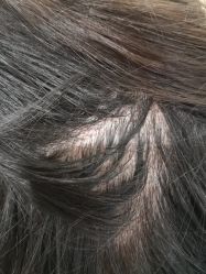 -碧莲盛·不剃发植发