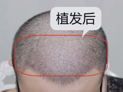 -大麦微针植发全国连锁