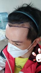 -大麦微针植发丨全国连锁