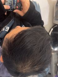 -大麦微针植发全国连锁