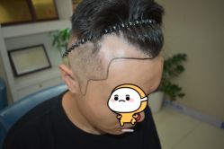 -大麦微针植发全国连锁