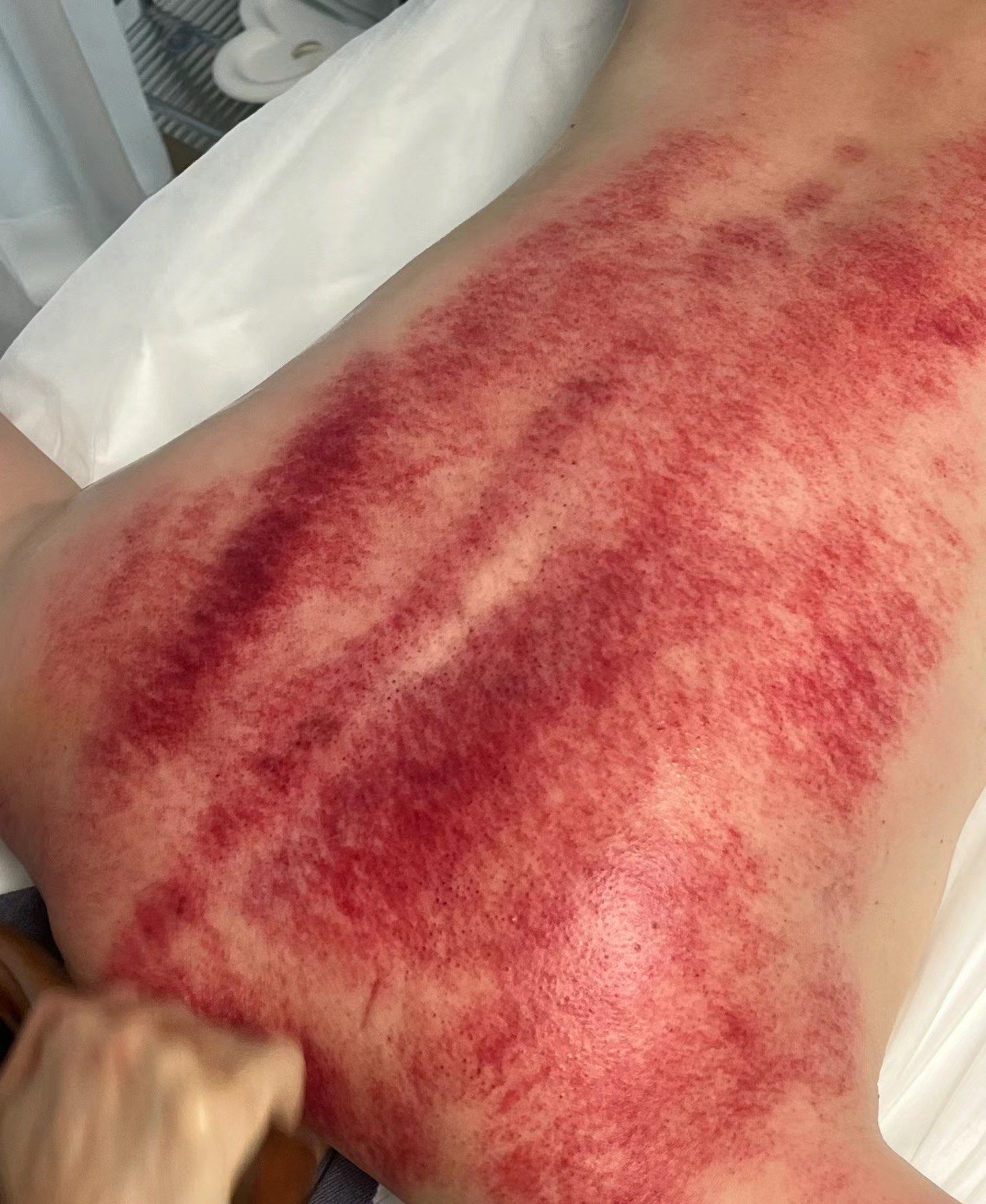 刮痧排毒 自从尝试了刮痧排毒,我的肩颈