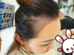 -大麦微针植发丨全国连锁