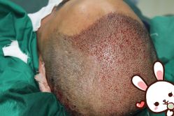 点击看大图 -大麦微针植发丨全国连锁