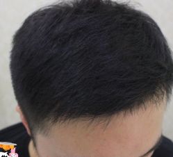 -大麦微针植发丨全国连锁