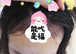 -大麦微针植发全国连锁