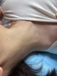 -爱莎扁平疣·汗管瘤·斑痣中心