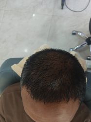 -大麦微针植发丨全国连锁