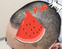 -大麦微针植发全国连锁