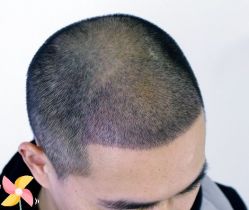 -大麦微针植发丨全国连锁