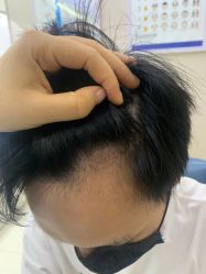 体验后-大麦微针植发丨全国连锁