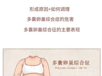 女性健康 | 多囊卵巢综合征是什么