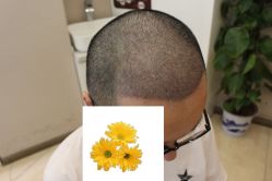 -大麦微针植发丨全国连锁