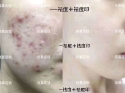 点击看大图 -佳慕·痘痘·问题肌管理中心