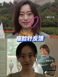体验前-More摩尔医美の注射线雕光电中心