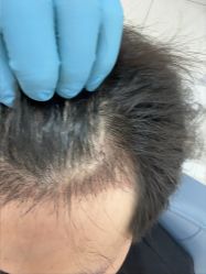 -大麦微针植发丨全国连锁