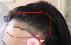 -大麦微针植发全国连锁