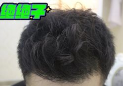 -大麦微针植发丨全国连锁