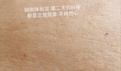 体验后-杭州米兰柏羽医疗美容医院