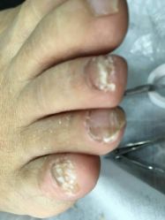 点击看大图 -德哥灰指甲脚气甲沟炎跖疣护理