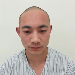 -碧莲盛·不剃发植发
