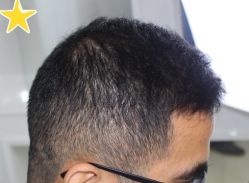 -大麦微针植发丨全国连锁