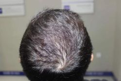 -大麦微针植发全国连锁