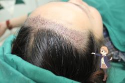 -大麦微针植发丨全国连锁