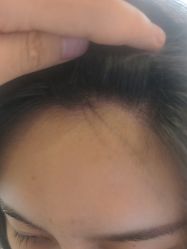 -碧莲盛·不剃发植发