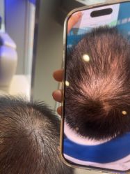 -碧莲盛·不剃发植发