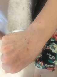 -爱莎扁平疣·汗管瘤·斑痣中心