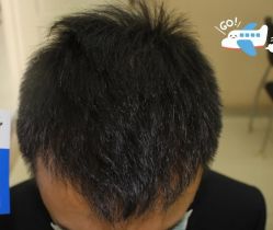 -大麦微针植发丨全国连锁