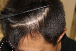 -大麦微针植发丨全国连锁