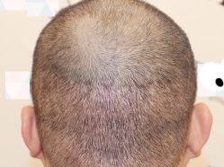 -大麦微针植发全国连锁