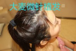 -大麦微针植发丨全国连锁