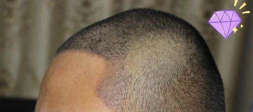 -大麦微针植发丨全国连锁