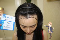 -大麦微针植发丨全国连锁