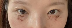 -爱莎扁平疣·汗管瘤·斑痣中心
