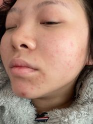 -蕾特恩专业祛痘