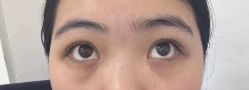体验后-杭州米兰柏羽医疗美容医院