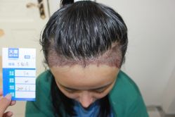 -大麦微针植发丨全国连锁