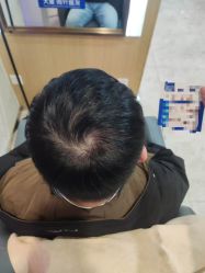 -大麦微针植发丨全国连锁