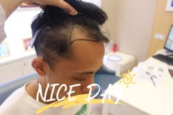 -大麦微针植发全国连锁