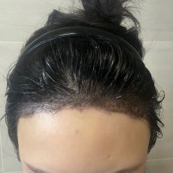 -大麦微针植发丨全国连锁