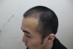 点击看大图 -大麦微针植发丨全国连锁