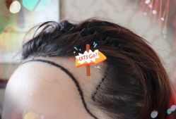 -大麦微针植发全国连锁