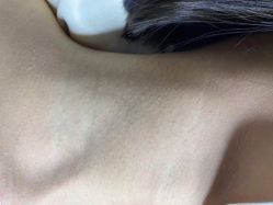 体验后-爱莎扁平疣·汗管瘤·斑痣中心