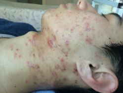 android_upload_pic-韩医生专业祛痘连锁机构