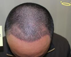 -大麦微针植发丨全国连锁