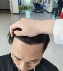 体验后-大麦微针植发全国连锁